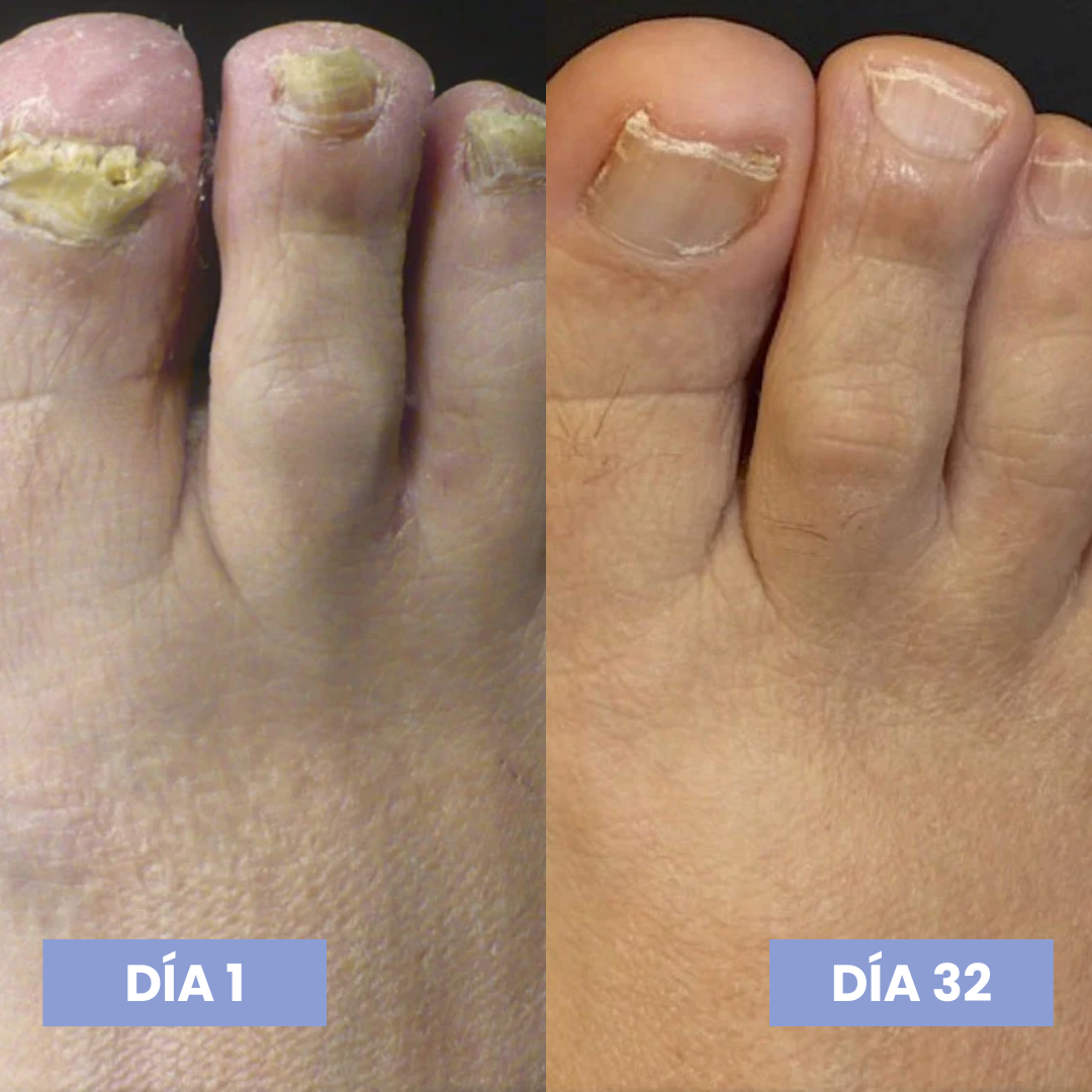 Lunavia™ Lápiz Antihongos