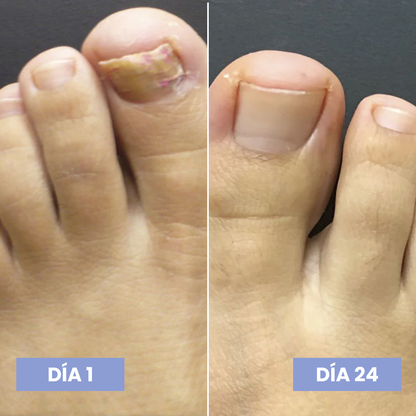 Lunavia™ Lápiz Antihongos